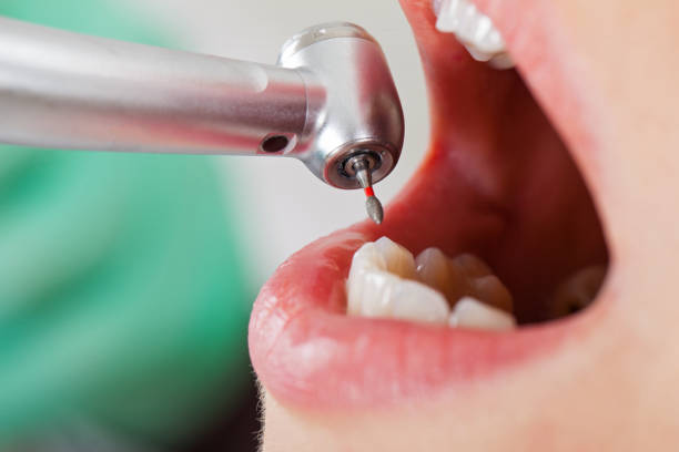 Best Emergency Treatment for Oral Infections in Rock Island, WA